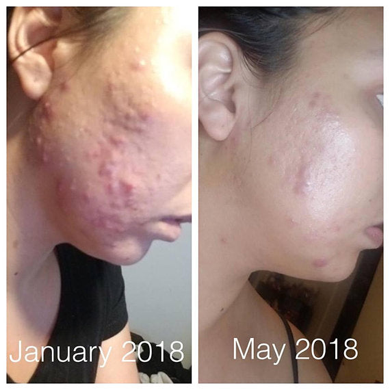 Super Acne Fighter | Organic Acne Treatment | Acne Detail human