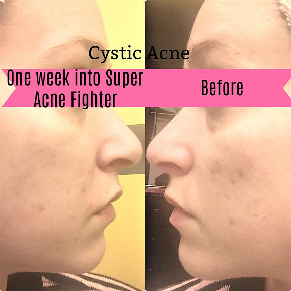 Super Acne Fighter | Organic Acne Treatment | Acne detail human 2